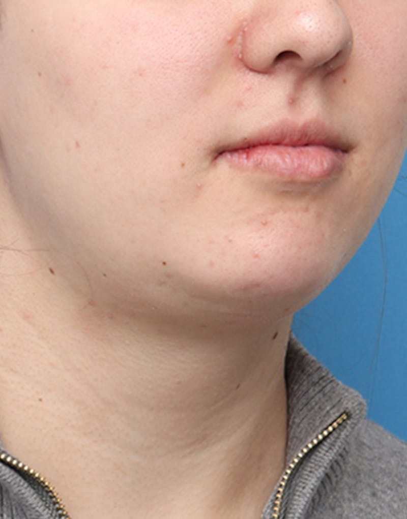 FaceTite Before & After Gallery - Patient 161350 - Image 4