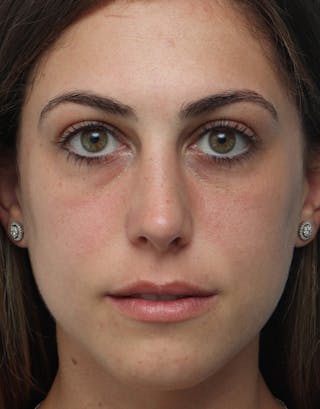 Rhinoplasty Before & After Gallery - Patient 364495 - Image 4