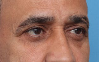 Eyelid Surgery Before & After Gallery - Patient 124571 - Image 4