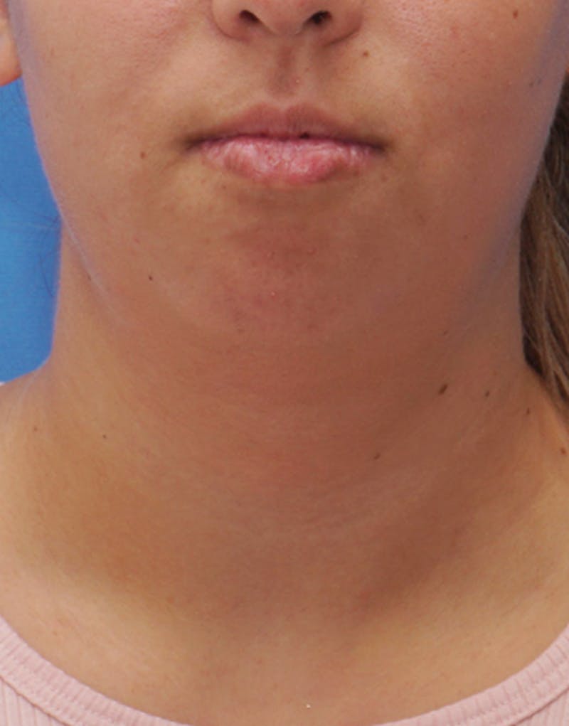 FaceTite Before & After Gallery - Patient 161350 - Image 5