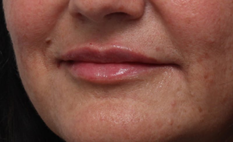 Lip Fillers Before & After Gallery - Patient 164605 - Image 6