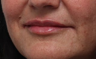 Lip Fillers Before & After Gallery - Patient 164605 - Image 6
