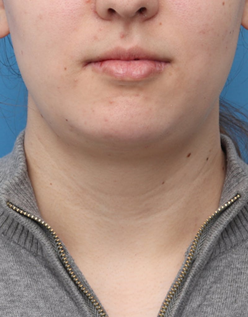 FaceTite Before & After Gallery - Patient 161350 - Image 6