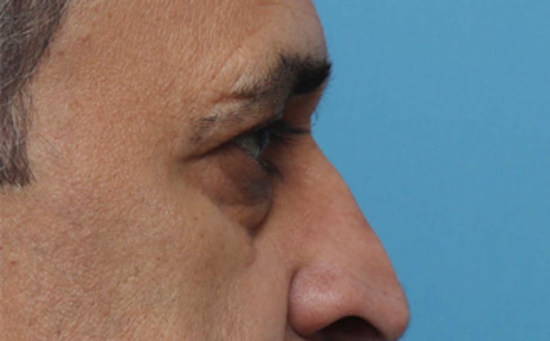 Eyelid Surgery Before & After Gallery - Patient 124571 - Image 7