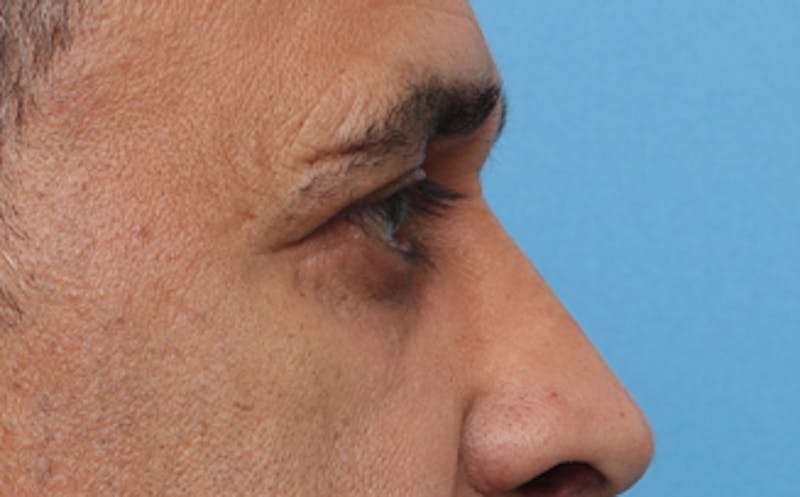 Eyelid Surgery Before & After Gallery - Patient 124571 - Image 8