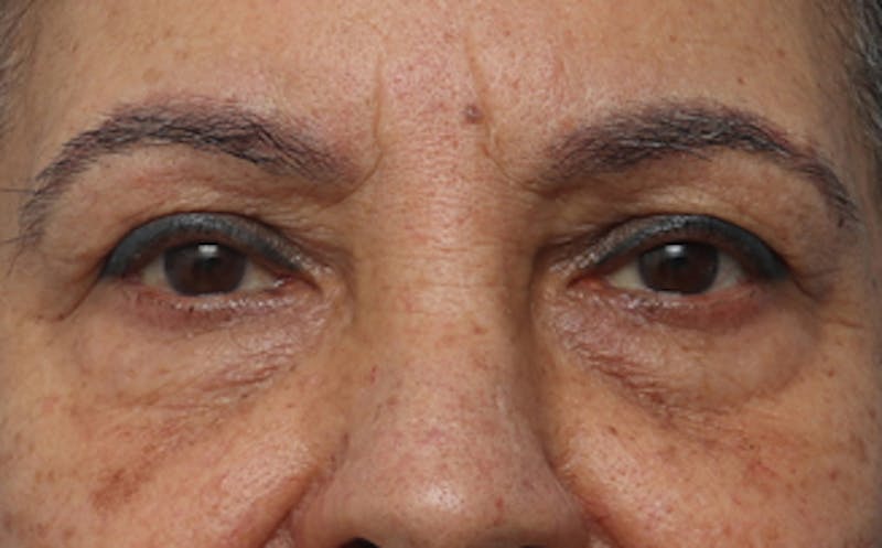 Patient CCbNFfsWTiuUVGxziK_iUw - Eyelid Surgery Before & After Photos