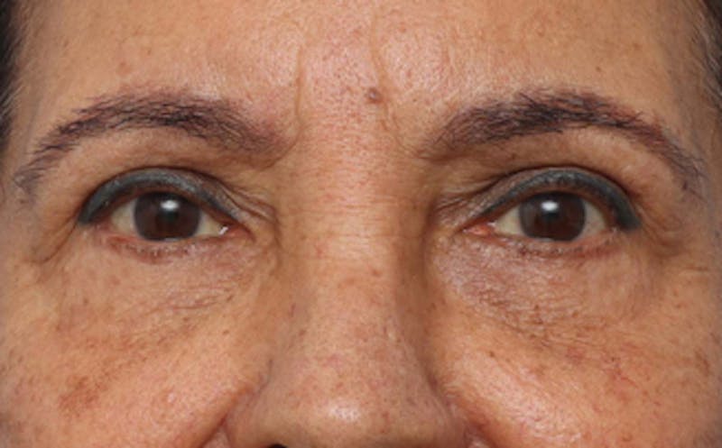 Eyelid Surgery Before & After Gallery - Patient 237825 - Image 2