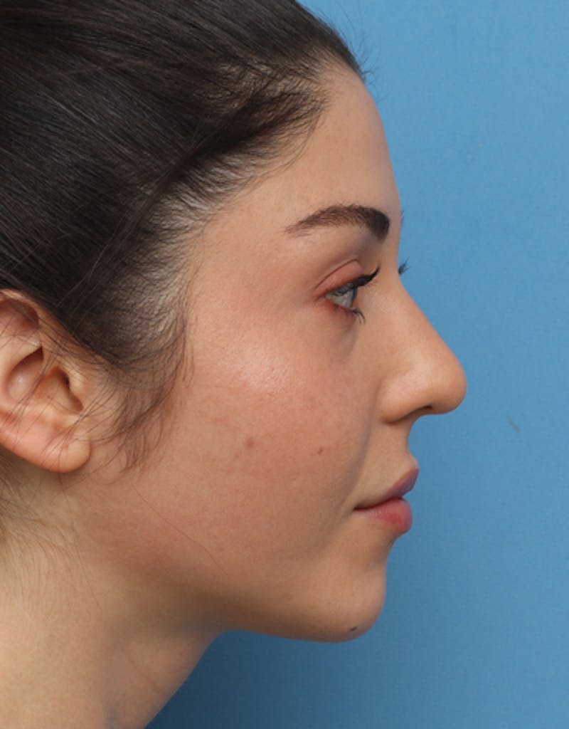 Chin Surgery Before & After Gallery - Patient 391078 - Image 2