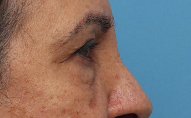 Eyelid Surgery Before & After Gallery - Patient 237825 - Image 3