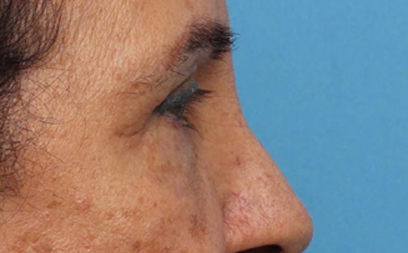Eyelid Surgery Before & After Gallery - Patient 237825 - Image 4