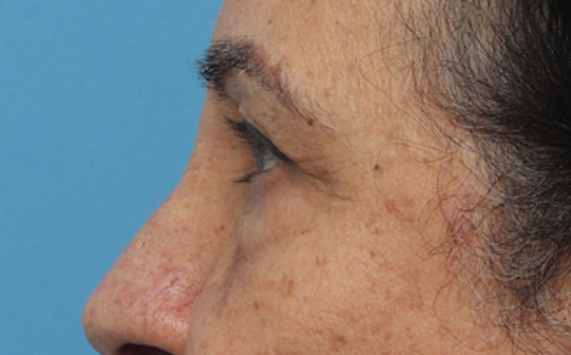 Eyelid Surgery Before & After Gallery - Patient 237825 - Image 5