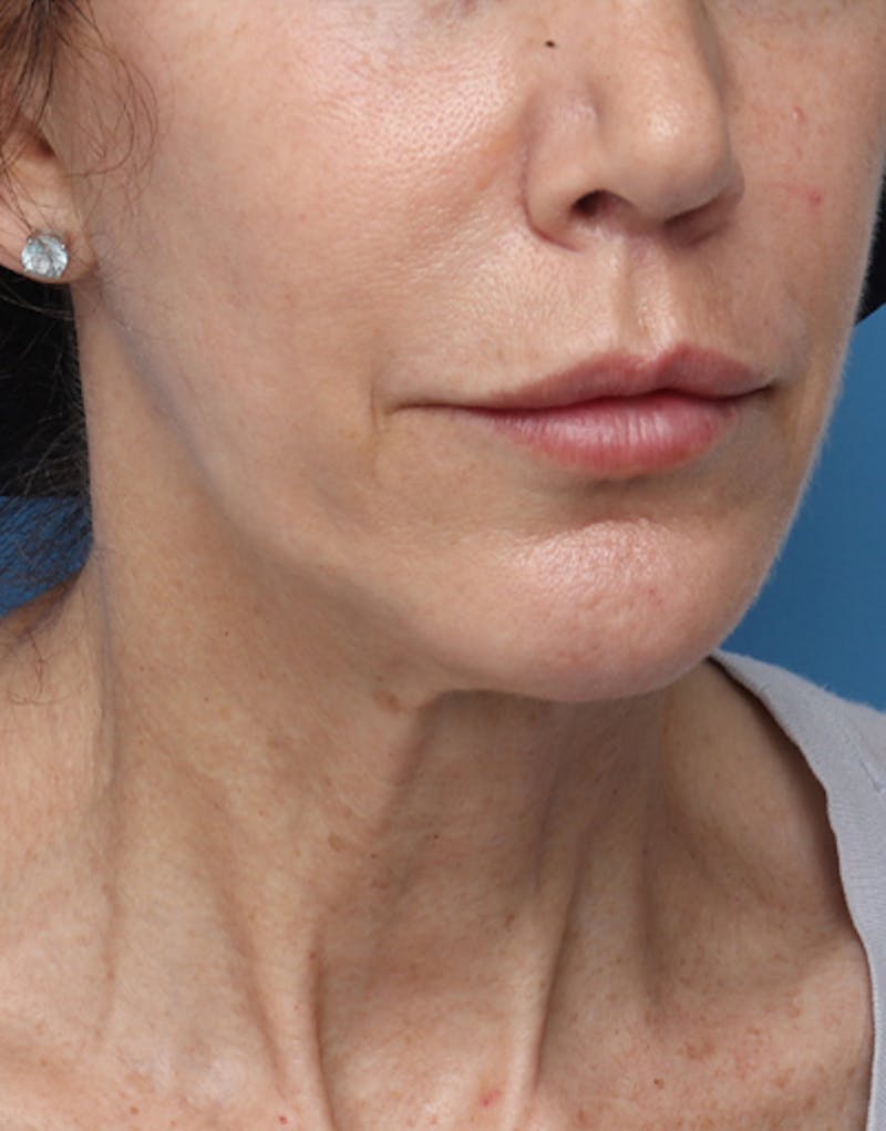 FaceTite Before & After Gallery - Patient 128201 - Image 8