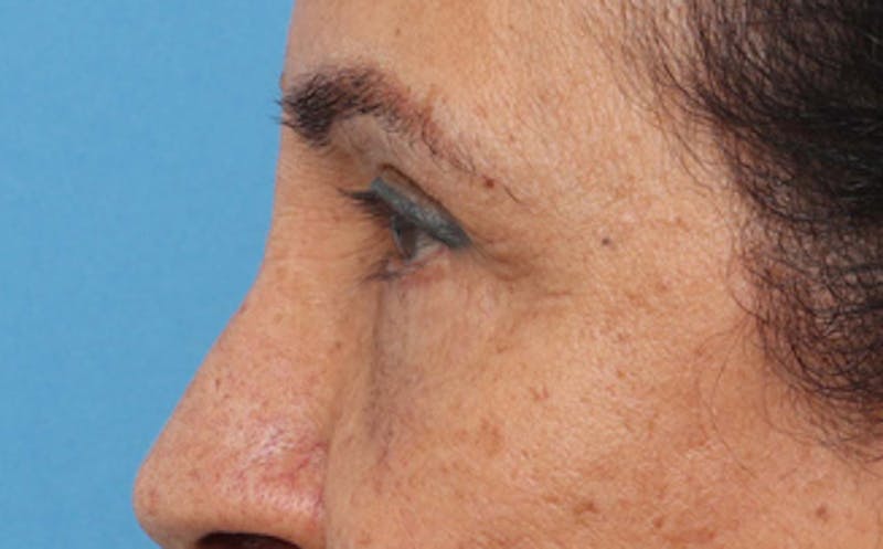 Eyelid Surgery Before & After Gallery - Patient 237825 - Image 6