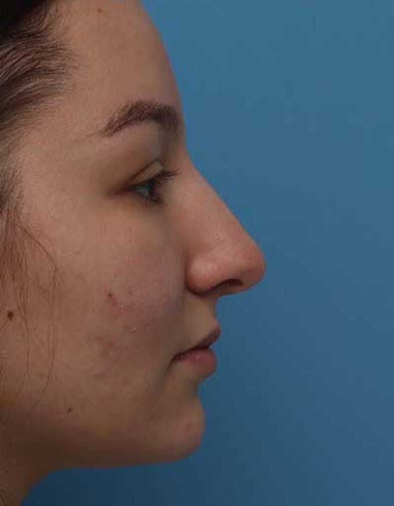Rhinoplasty Before & After Gallery - Patient 203225 - Image 1
