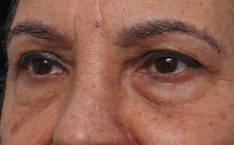 Eyelid Surgery Before & After Gallery - Patient 237825 - Image 7