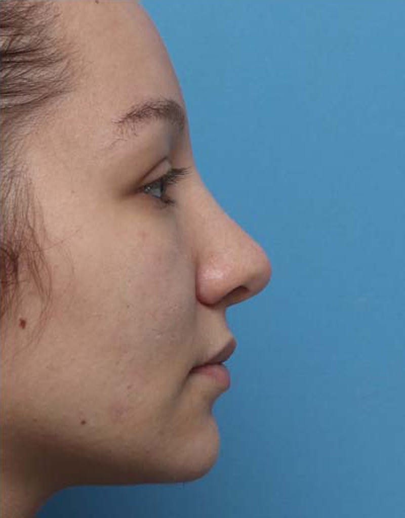 Rhinoplasty Before & After Gallery - Patient 203225 - Image 2
