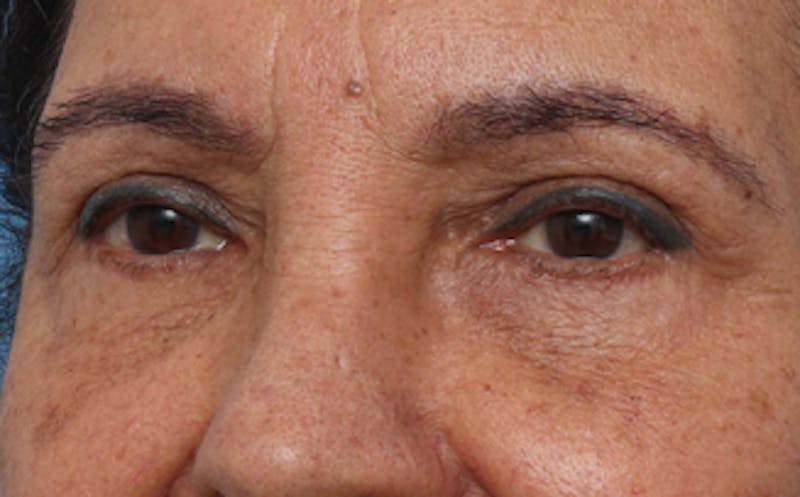 Eyelid Surgery Before & After Gallery - Patient 237825 - Image 8