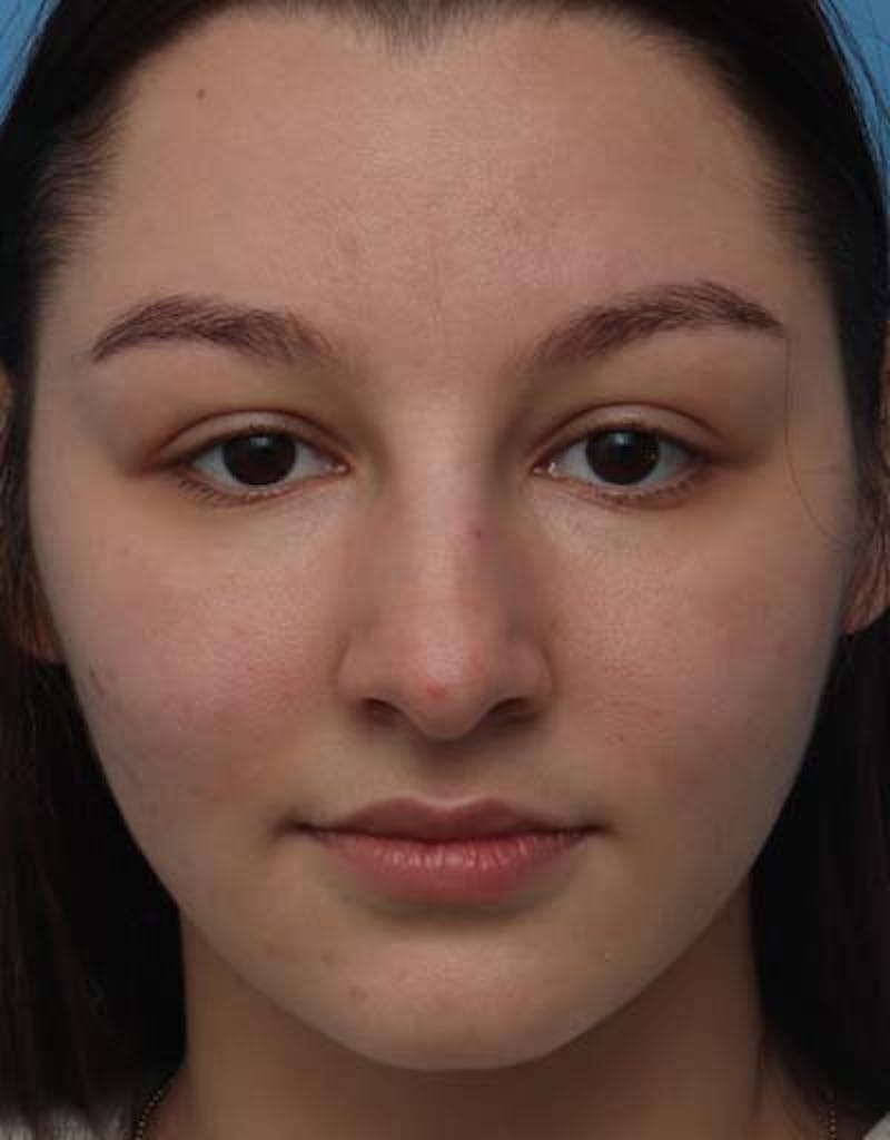 Rhinoplasty Before & After Gallery - Patient 203225 - Image 3