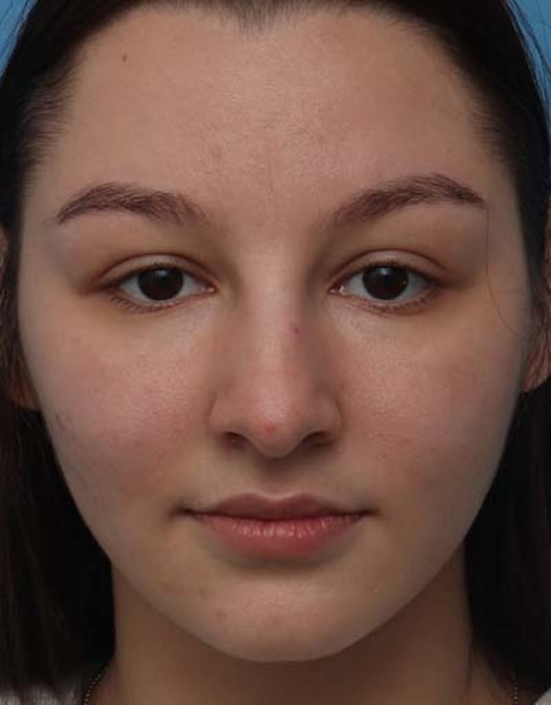 Rhinoplasty  Before & After Gallery - Patient 170900 - Image 3