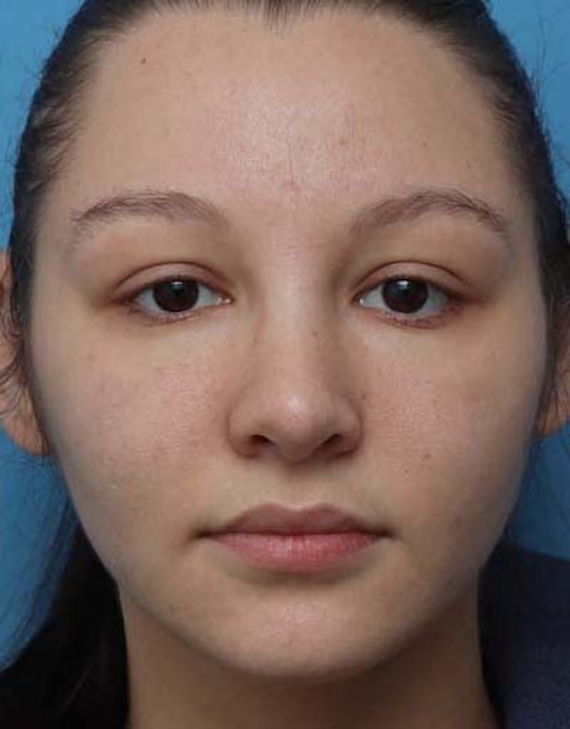 Rhinoplasty  Before & After Gallery - Patient 170900 - Image 4