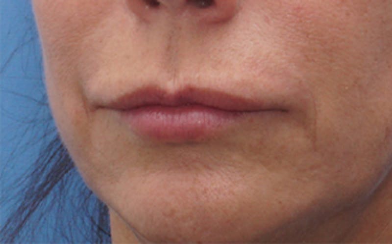 Lip Lift Before & After Gallery - Patient 163401 - Image 3