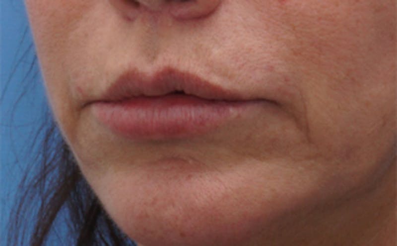 Lip Lift Before & After Gallery - Patient 163401 - Image 4
