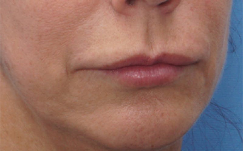 Lip Lift Before & After Gallery - Patient 163401 - Image 5