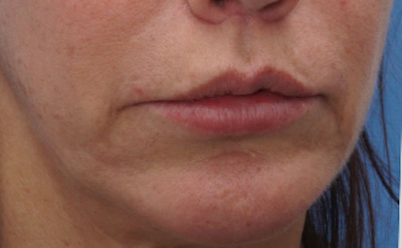 Lip Lift Before & After Gallery - Patient 163401 - Image 6