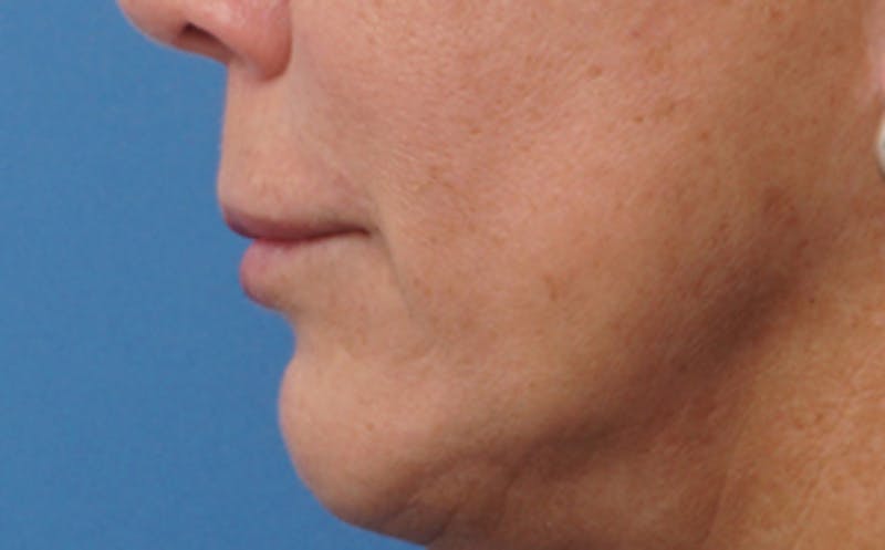 Lip Lift Before & After Gallery - Patient 163401 - Image 7