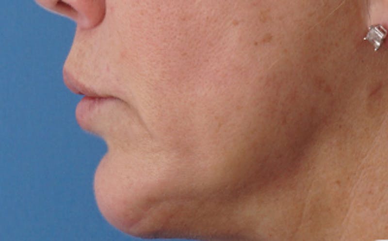 Lip Lift Before & After Gallery - Patient 163401 - Image 8