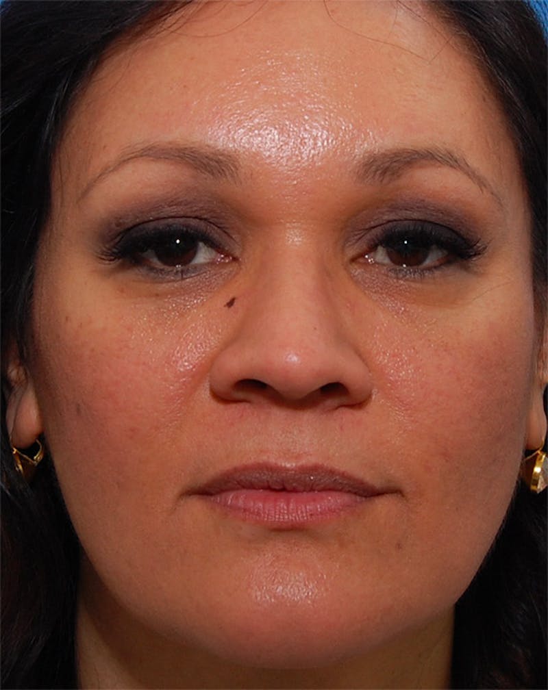 Fillers Before & After Gallery - Patient 265370 - Image 1