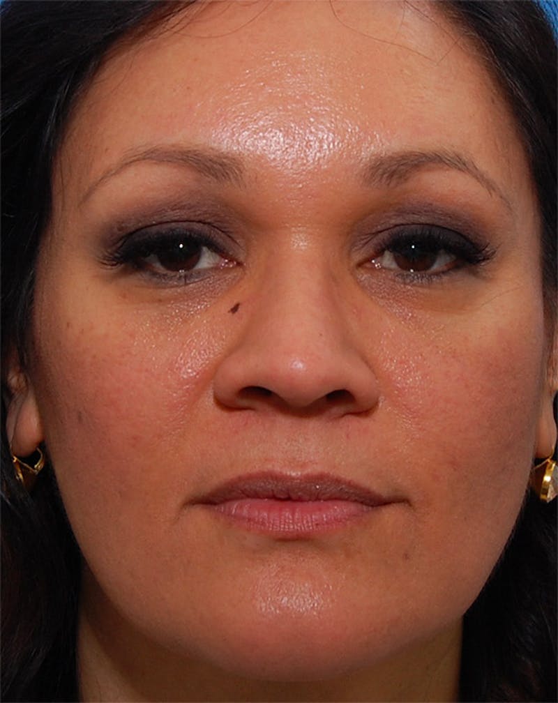 Patient J70Qgc-NSm-QFW6Svba66w - Fillers Before & After Photos