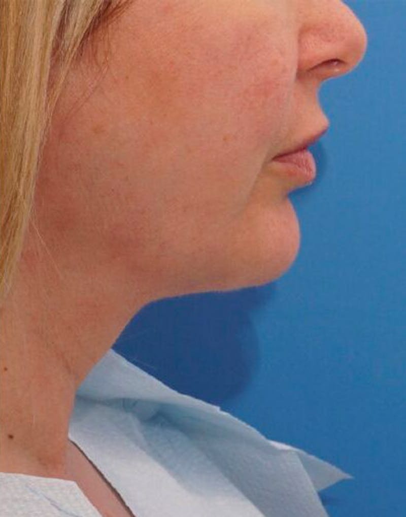 FaceTite Before & After Gallery - Patient 399524 - Image 2