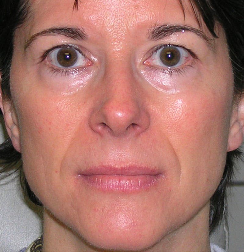 Fillers Before & After Gallery - Patient 213155 - Image 1