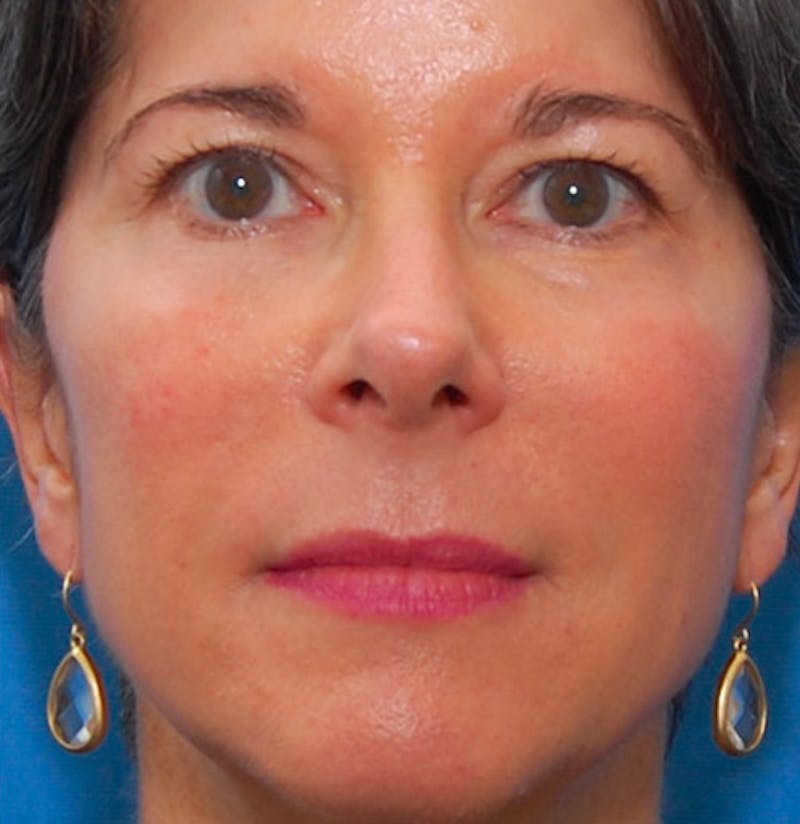 Fillers Before & After Gallery - Patient 213155 - Image 2