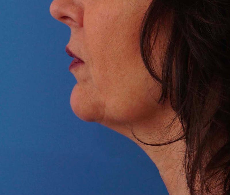 FaceTite Before & After Gallery - Patient 389862 - Image 1