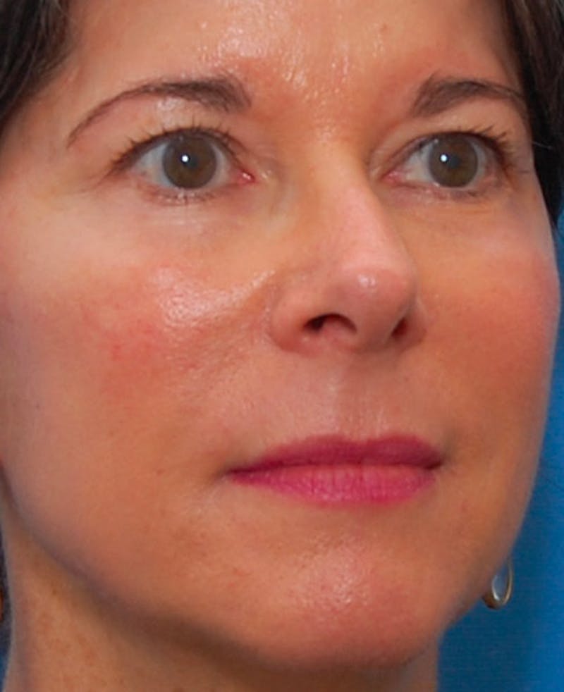 Fillers Before & After Gallery - Patient 213155 - Image 4