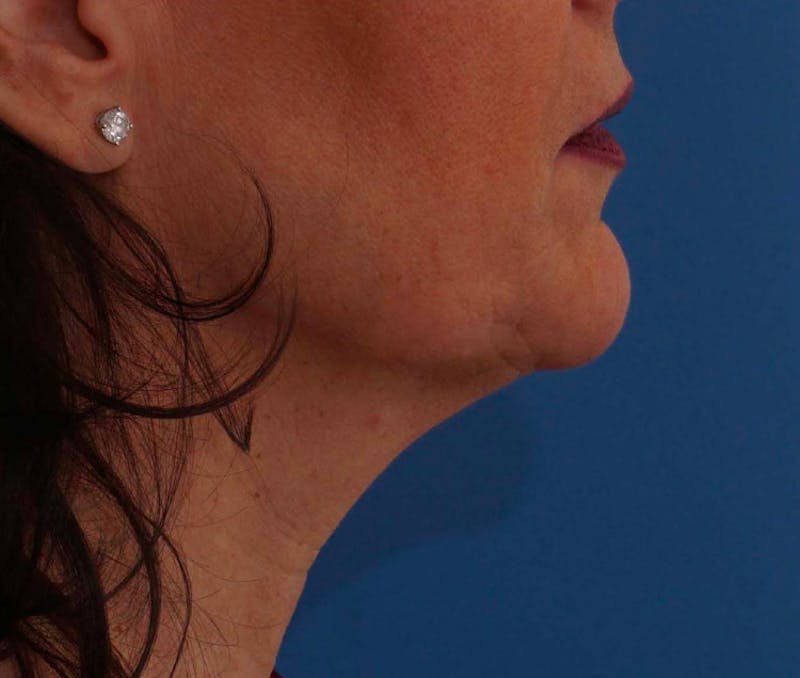 FaceTite Before & After Gallery - Patient 389862 - Image 3
