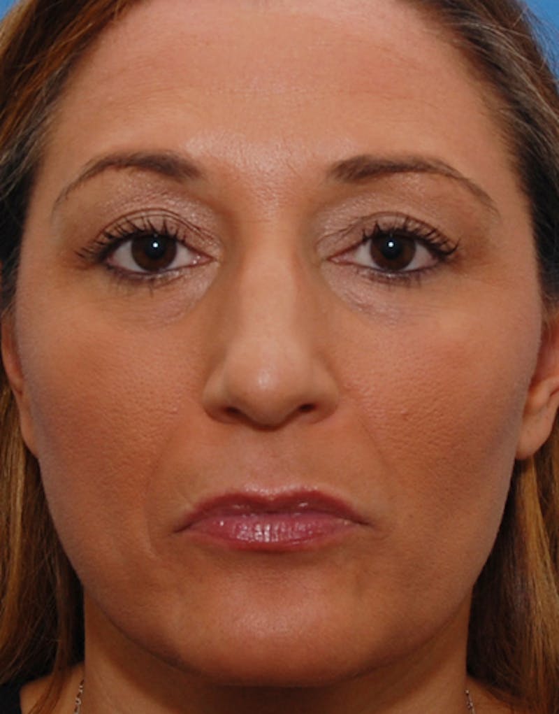 Rhinoplasty Before & After Gallery - Patient 744297 - Image 3
