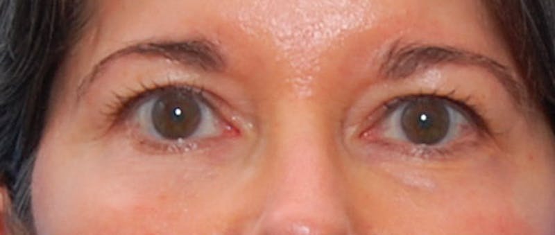 Fillers Before & After Gallery - Patient 213155 - Image 6