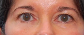 Fillers Before & After Gallery - Patient 213155 - Image 6