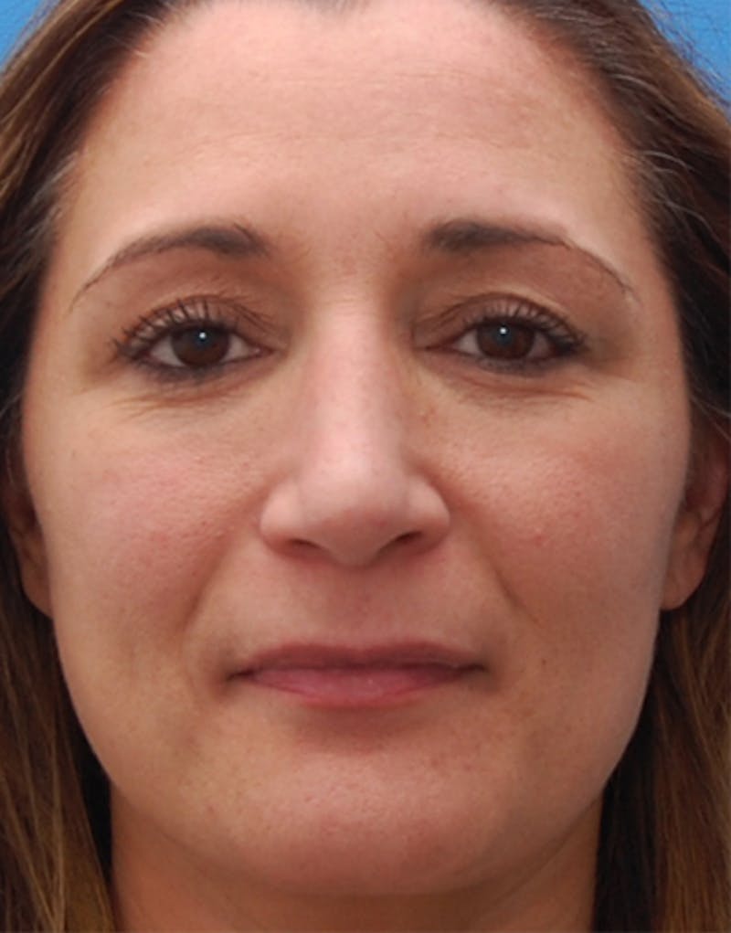 Rhinoplasty  Before & After Gallery - Patient 367423 - Image 4