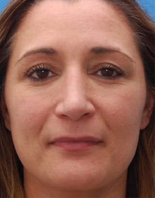 Rhinoplasty Before & After Gallery - Patient 367423 - Image 4