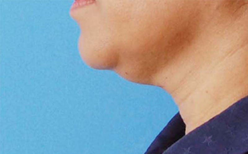 Patient BHvnD6MwQDCzYH4RzkfheQ - FaceTite Before & After Photos