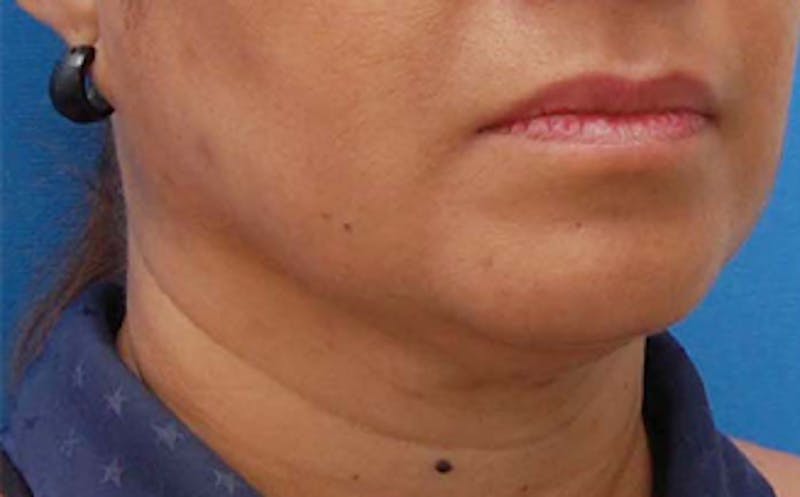 FaceTite Before & After Gallery - Patient 290745 - Image 3
