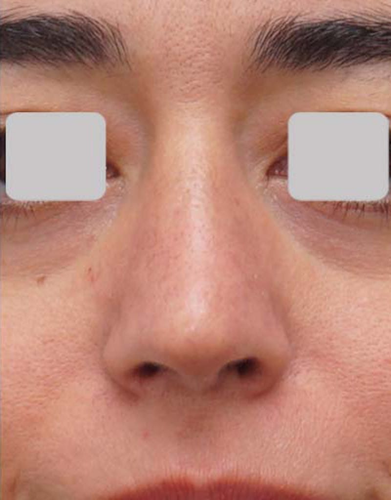 Fillers Before & After Gallery - Patient 130870 - Image 2