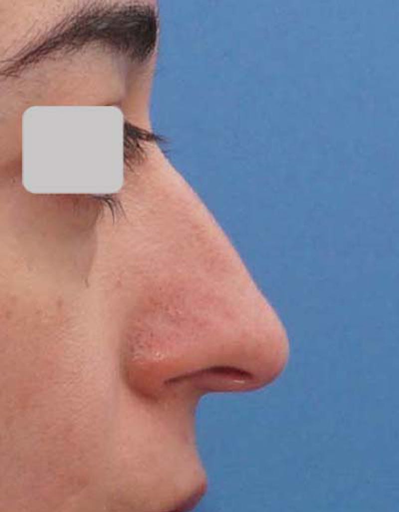 Fillers Before & After Gallery - Patient 130870 - Image 3
