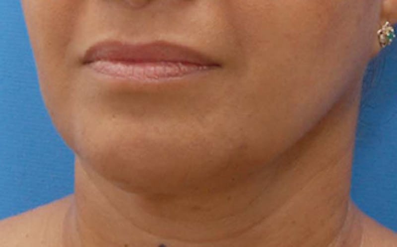 FaceTite Before & After Gallery - Patient 290745 - Image 6
