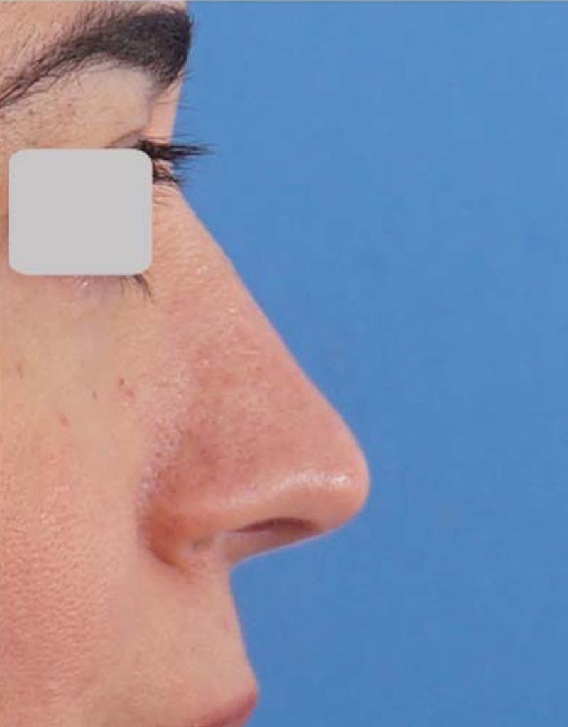 Fillers Before & After Gallery - Patient 130870 - Image 4