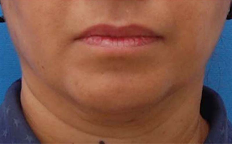 FaceTite Before & After Gallery - Patient 290745 - Image 7